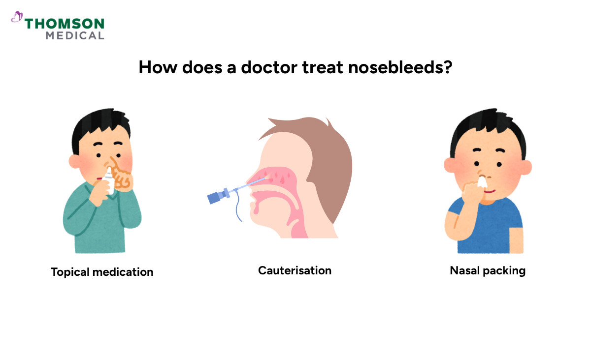 illustration of how does a doctor treat nosebleeds