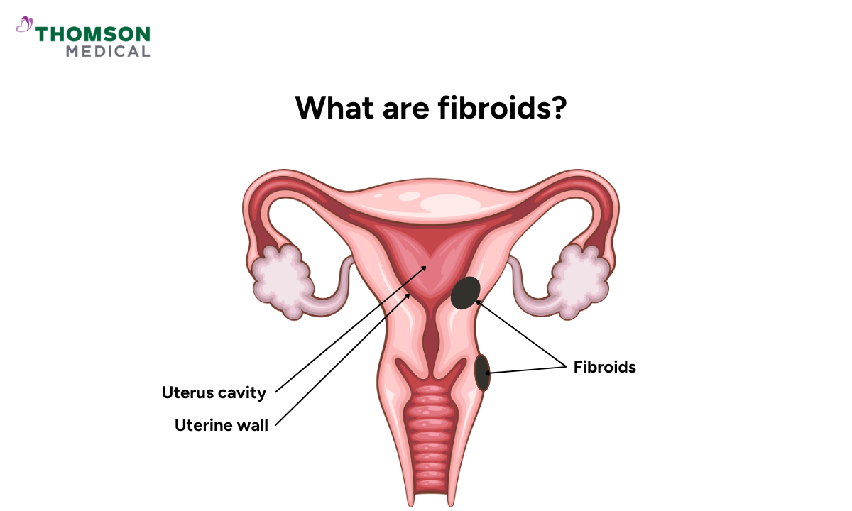 Illustration of fibroids in the uterus