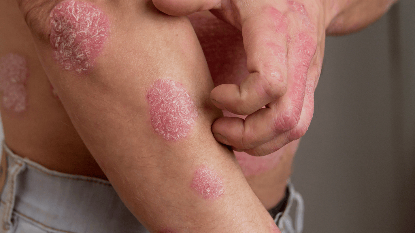 psoriasis