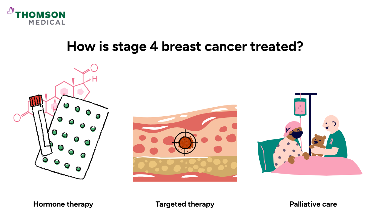 Illustration of how is stage 4 breast cancer treated