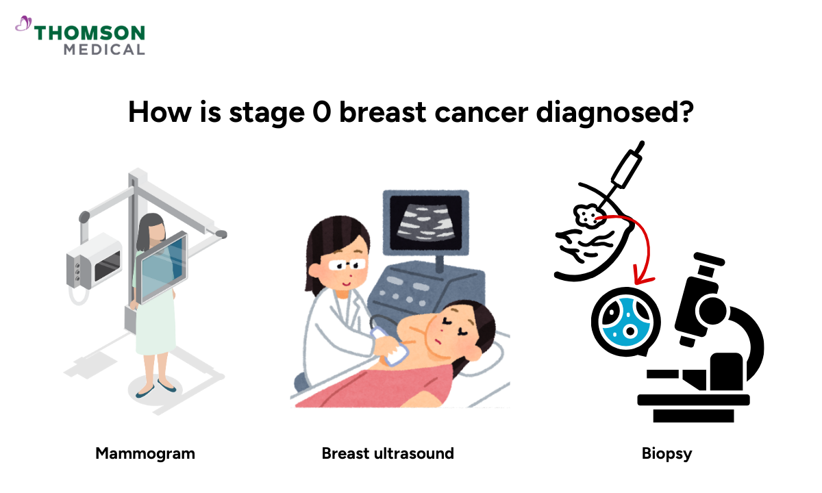 The illustration shows how stage 0 breast cancer is diagnosed