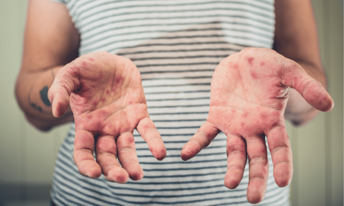 Image of hfmd on child's hands 