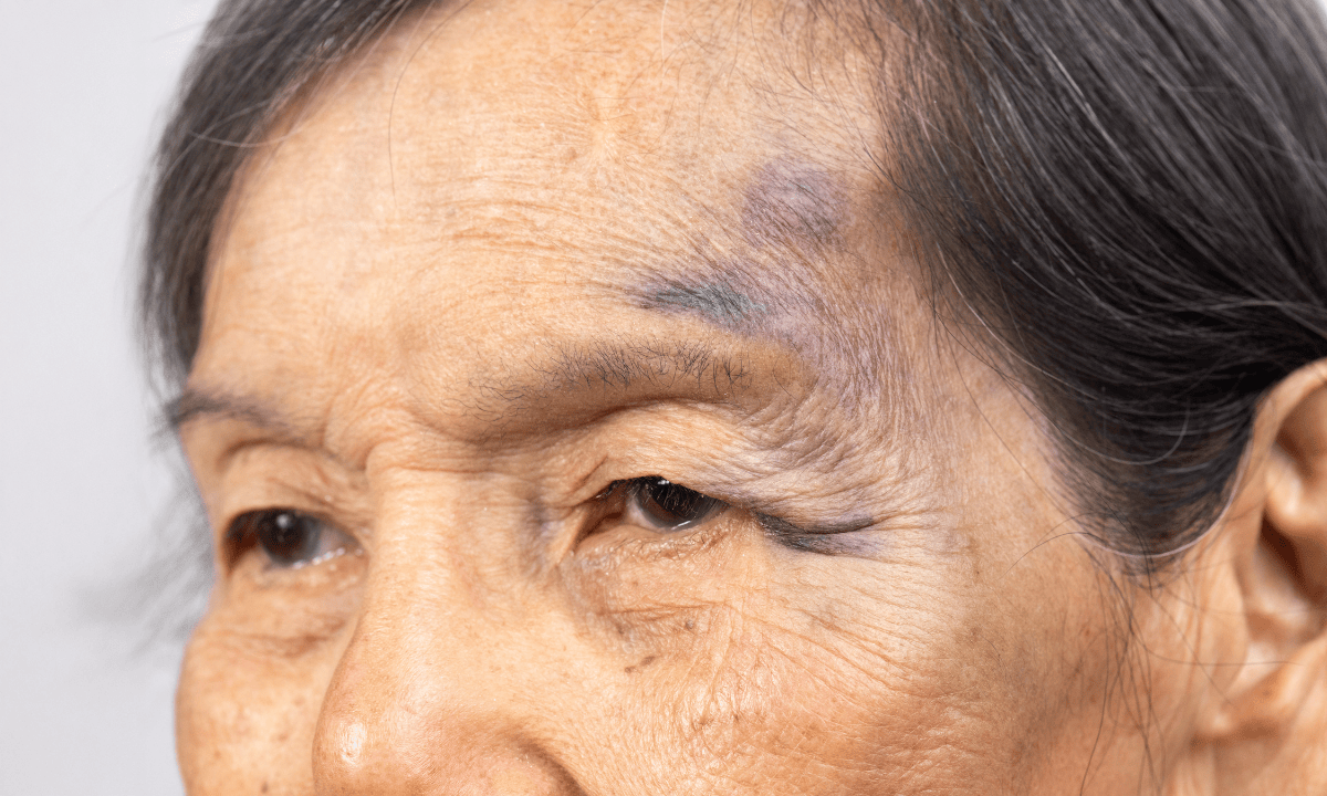 Minor bruises on an elderly woman’s head