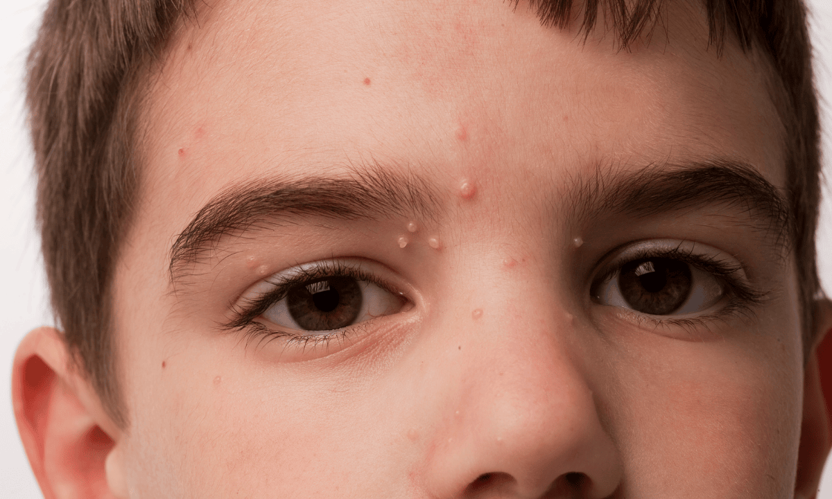 Image of molluscum contagiosum on child's face