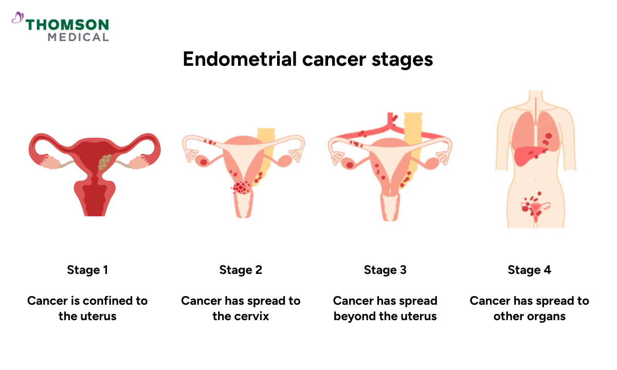 How Fast Does Endometrial Cancer Spread? What You Should Know | Thomson ...