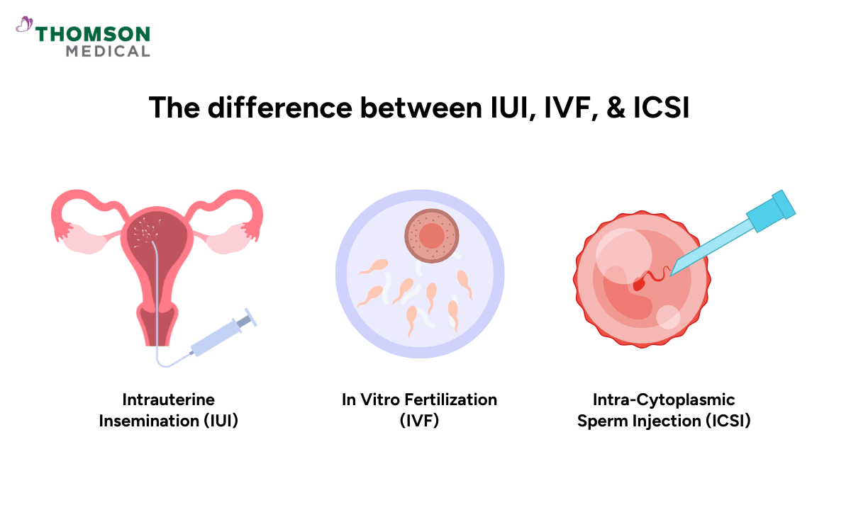 UI vs IVF vs ICSI
