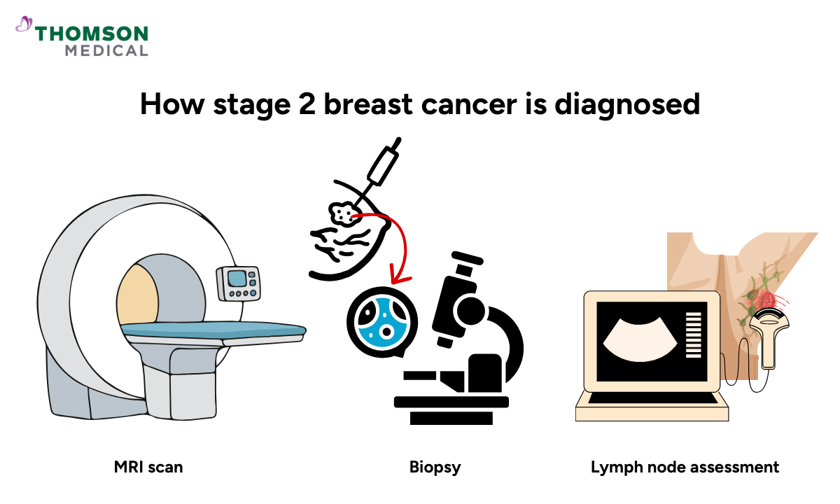 Illustration of how stage 2 breast cancer is diagnosed