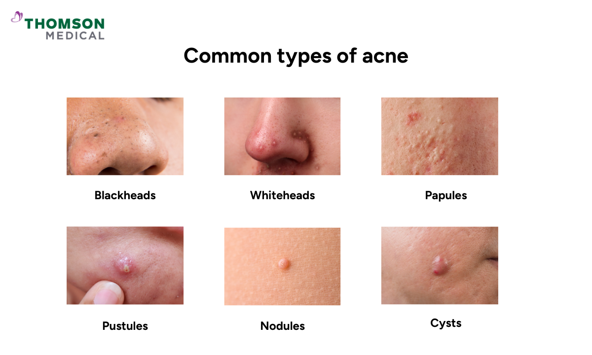 Illustration of common types of acne