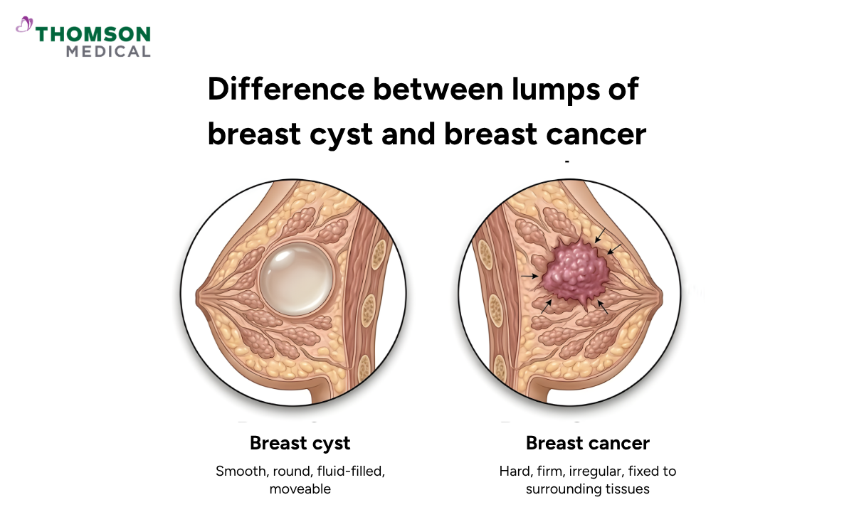 Comparison of a breast cyst (smooth, round, fluid-filled) versus breast cancer (hard, irregular, fixed to tissue).
