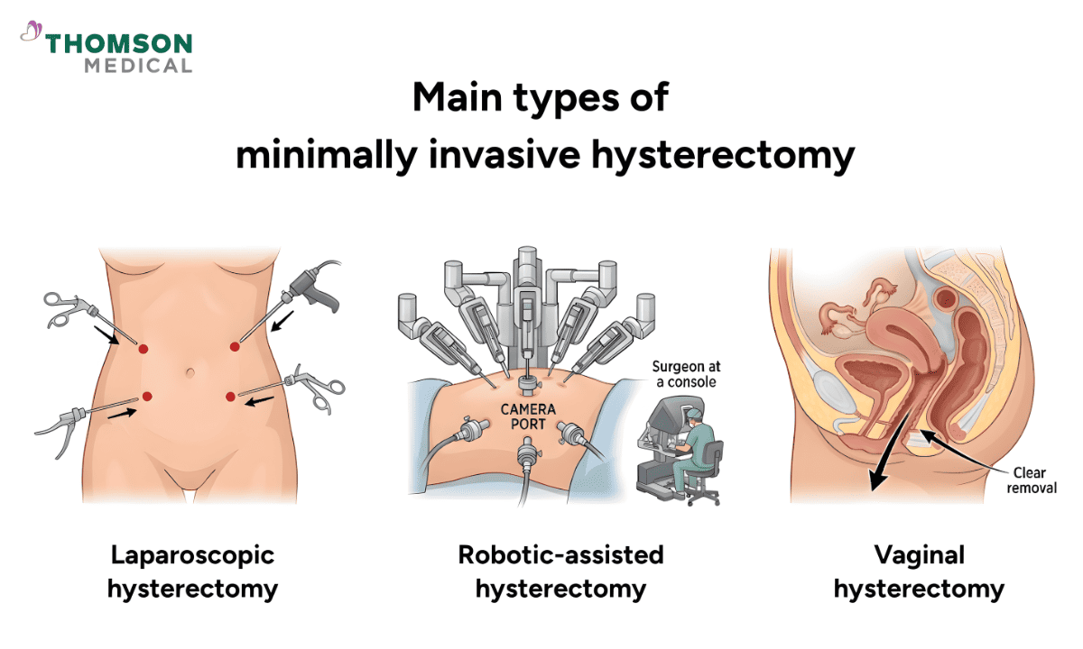llustration of three minimally invasive techniques: laparoscopic, robotic-assisted, and vaginal hysterectomy.