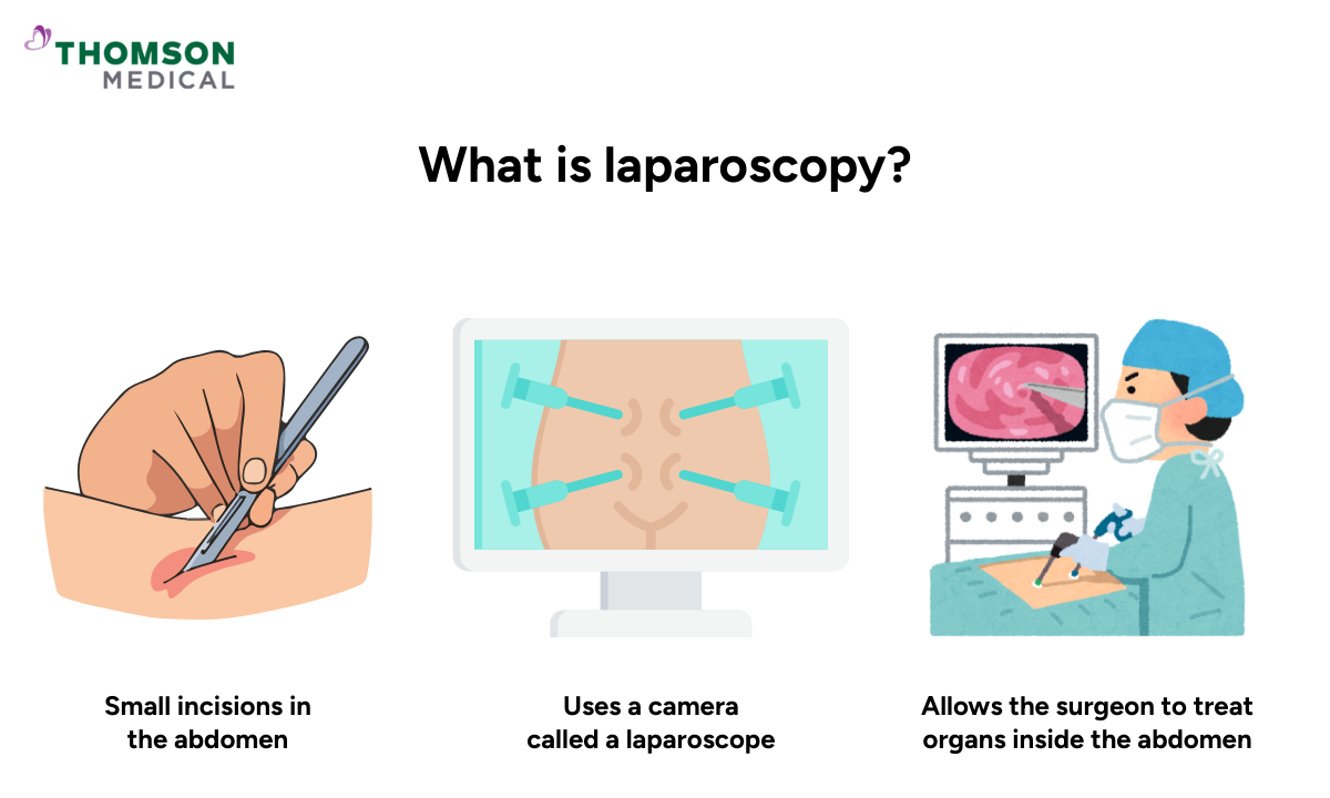 Illustration of what laparoscopy is.