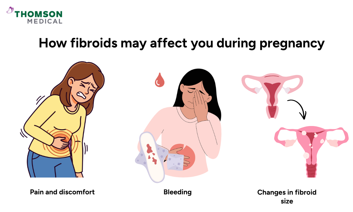 Illustration of how fibroids may affect you during pregnancy
