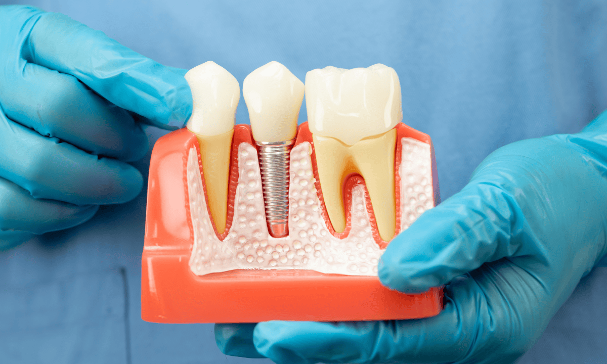 A dental implant model close up