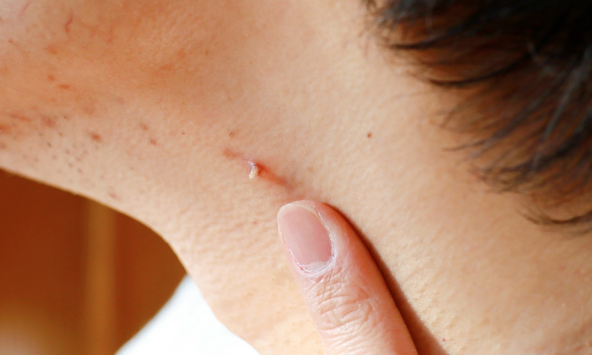 female experiencing warts