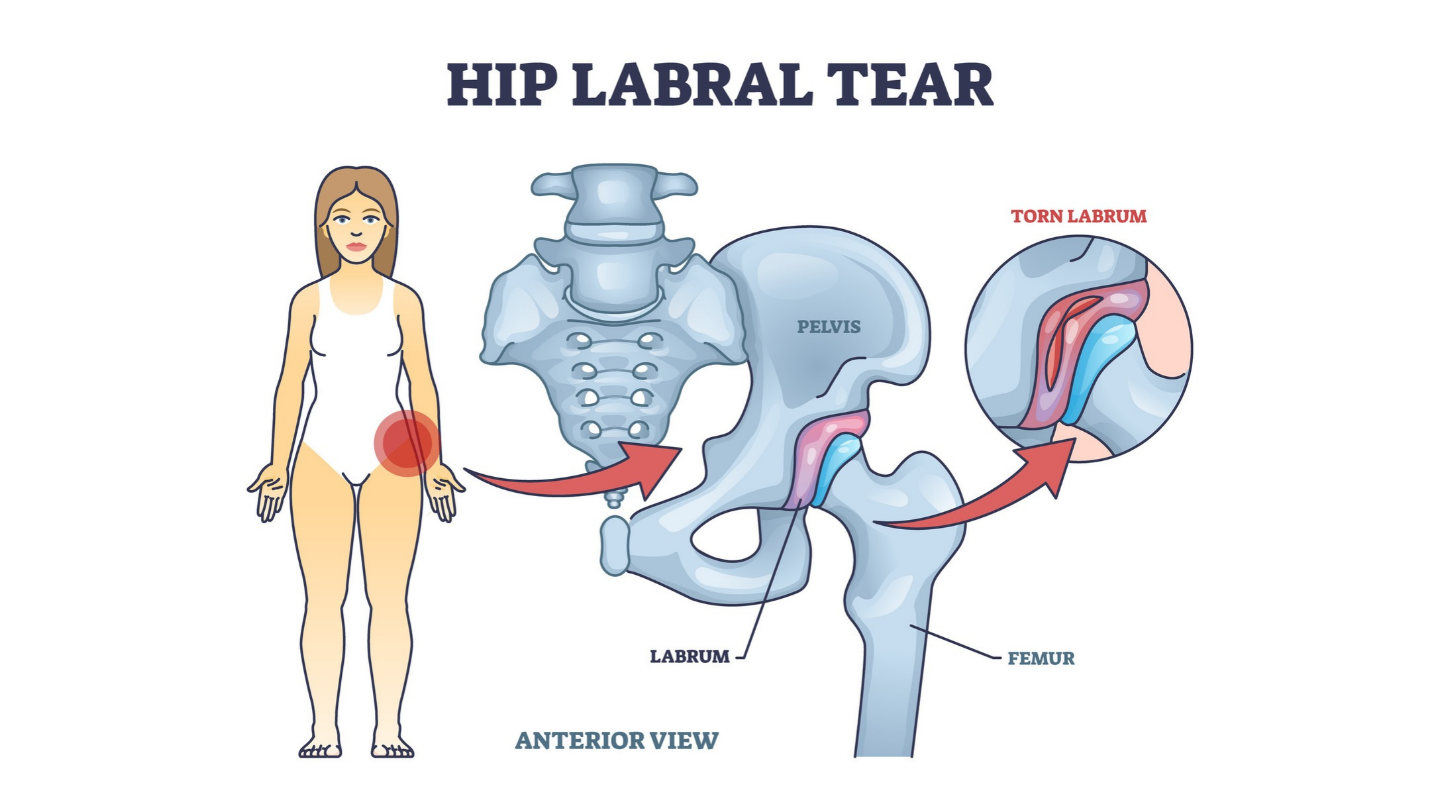 a-diagram-on-where-a-hip-labral-tear-occurs.png