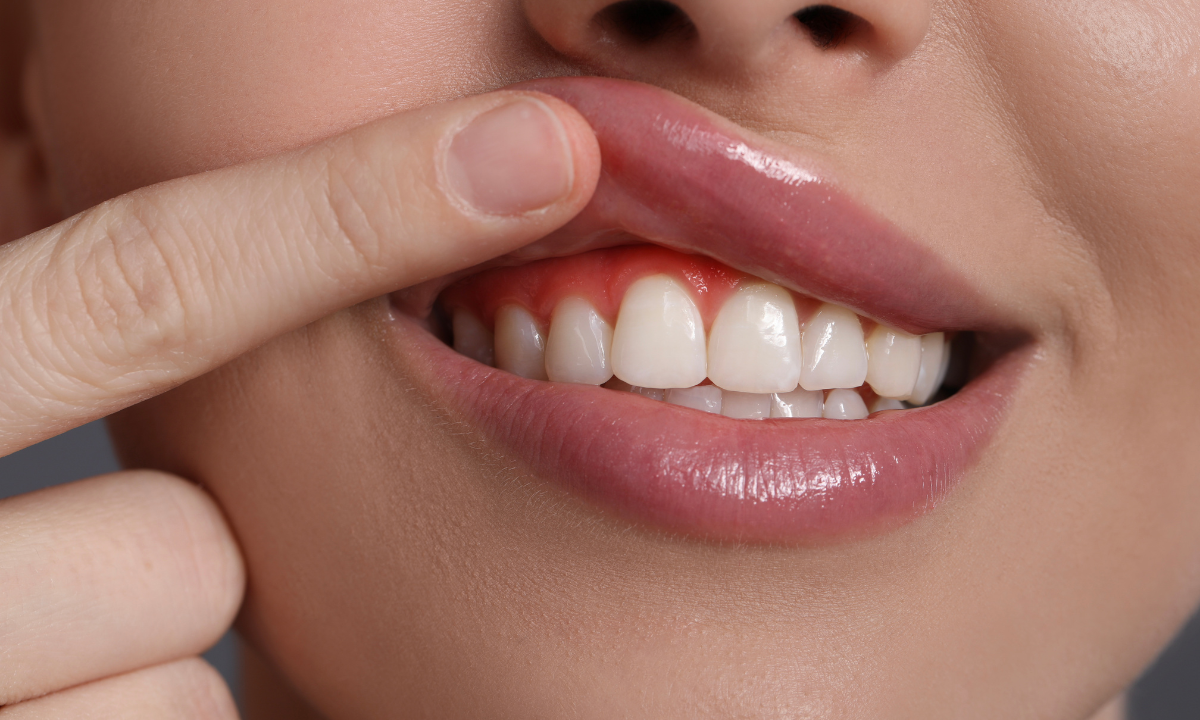 A close-up image of inflamed, red gums