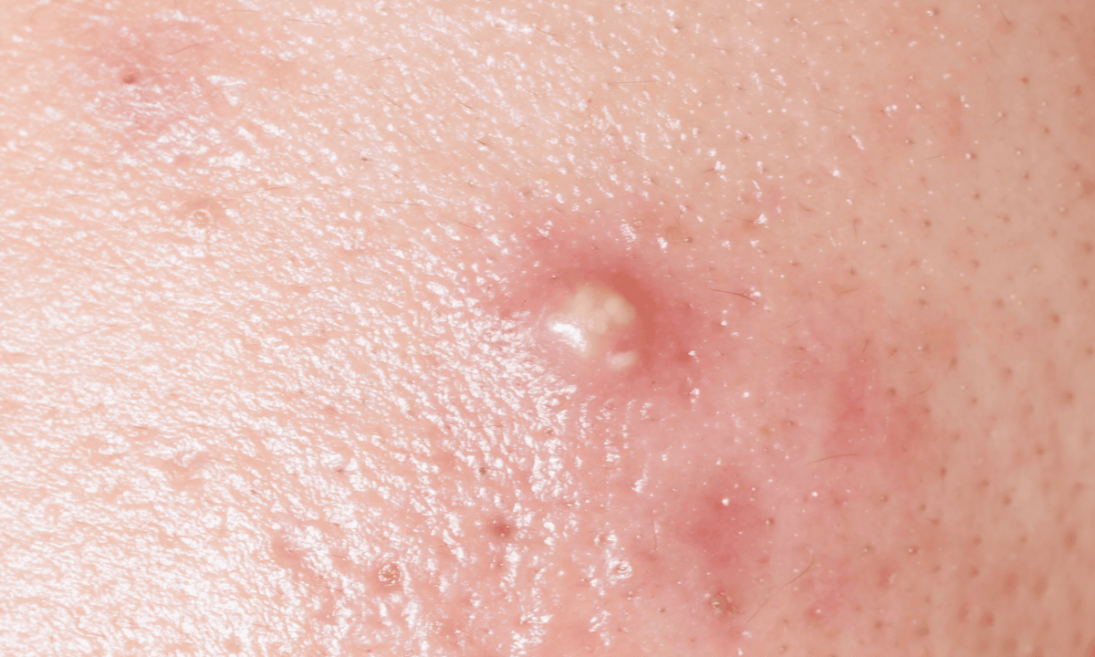blog-image_obgyn_pimple_(1).png