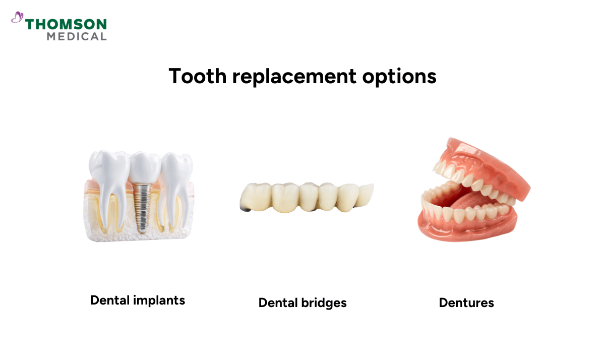 3 tooth replacement options
