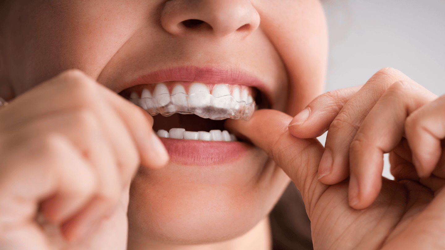 Clear Aligners: A Discreet Alternative to Traditional Braces | Thomson  Medical