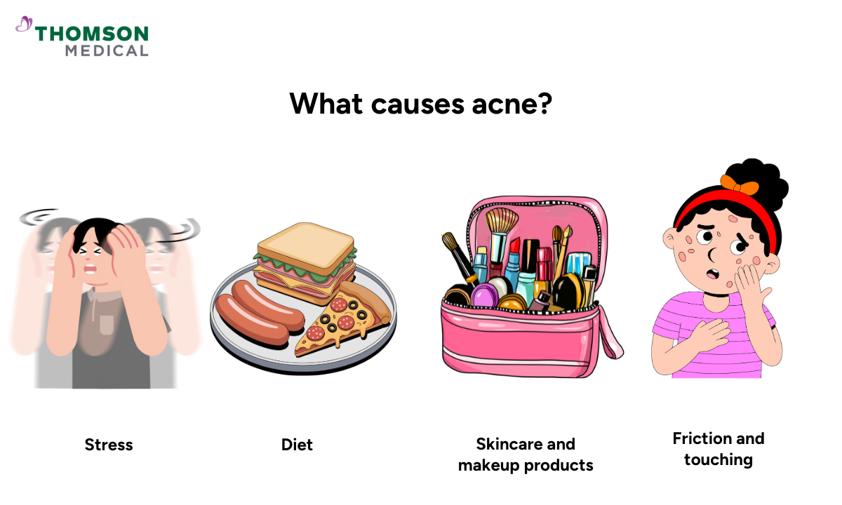 what causes acne