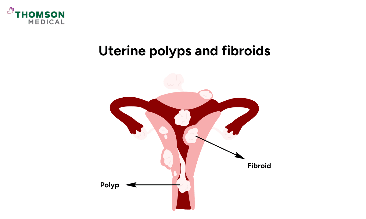image of polyp vs fibroid