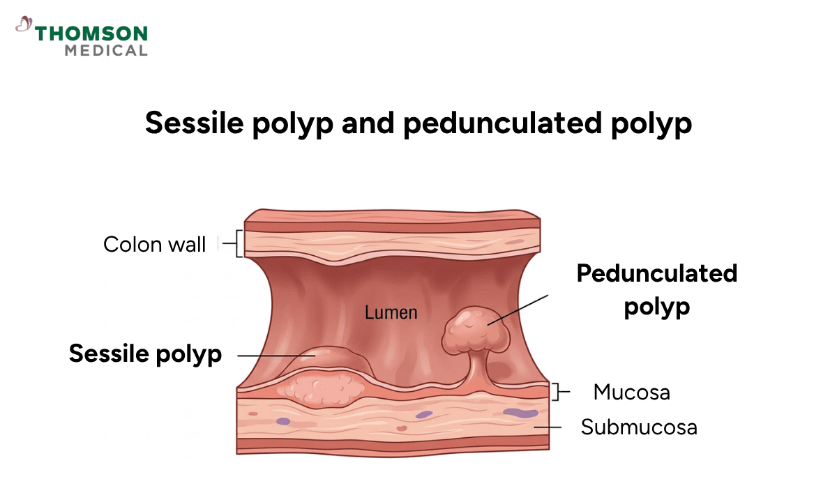 Diagram comparing a flat, dome-shaped sessile polyp to a mushroom-like pedunculated polyp on a colon wall.