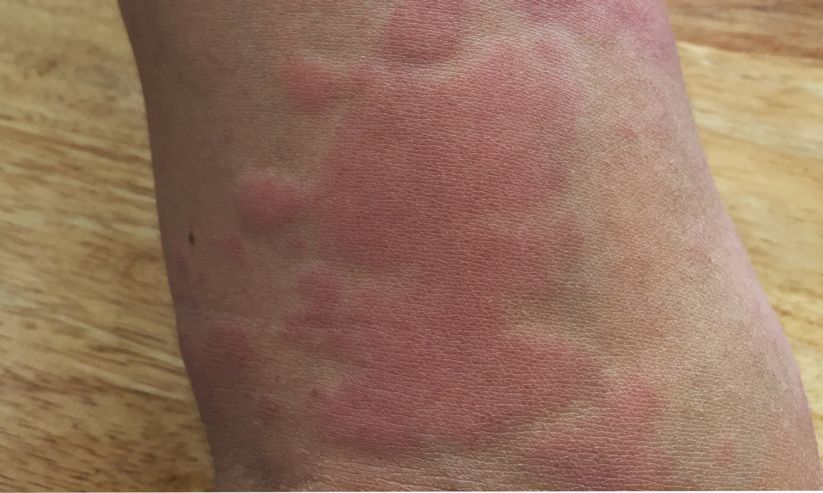Close-up view of a person's arm featuring large, raised red welts and rash patches commonly associated with hives.