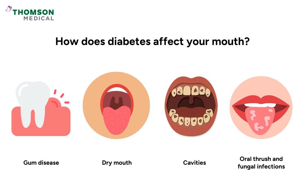 Illustration of how diabetes can affect your mouth
