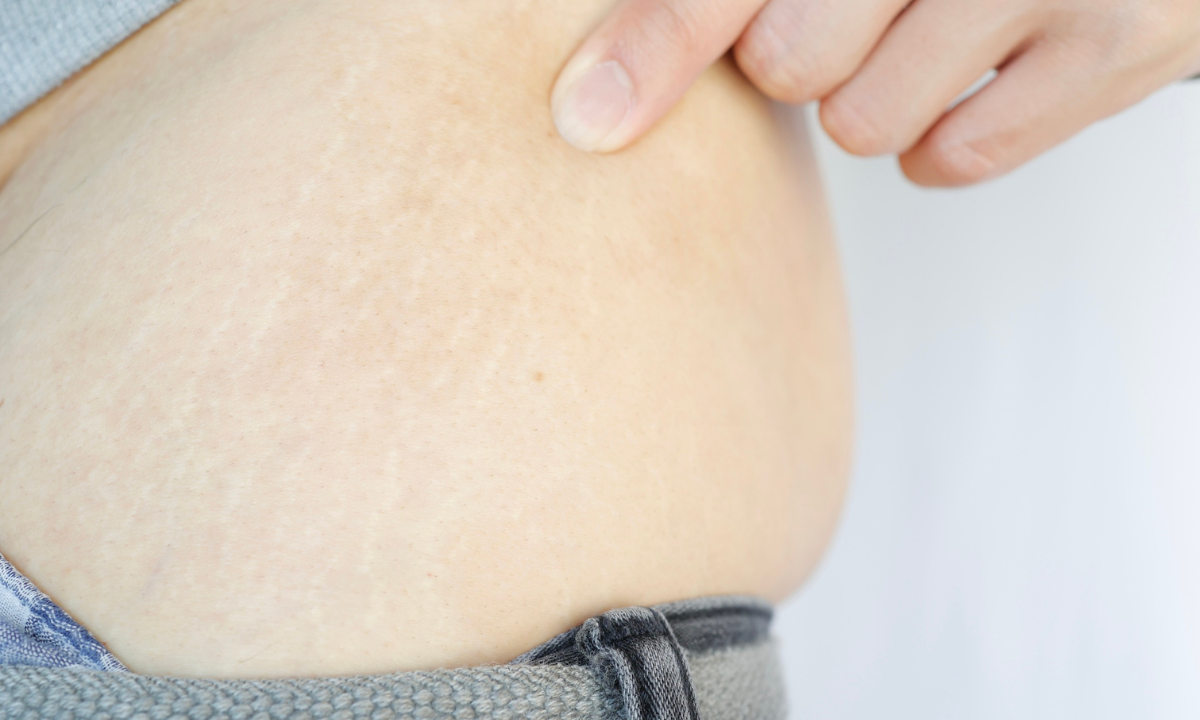 Close-up of stretch marks on the skin being pointed out by a finger.