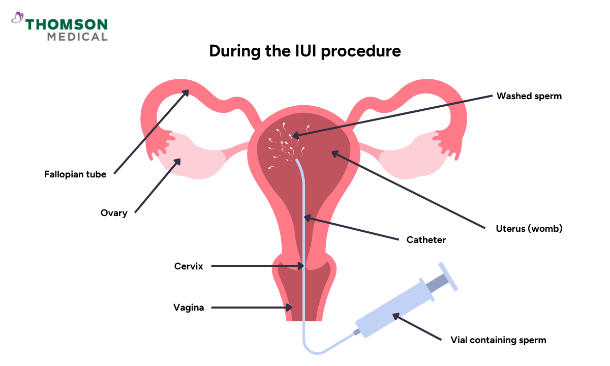 blog-image_obgyn_IUI-illustration.png