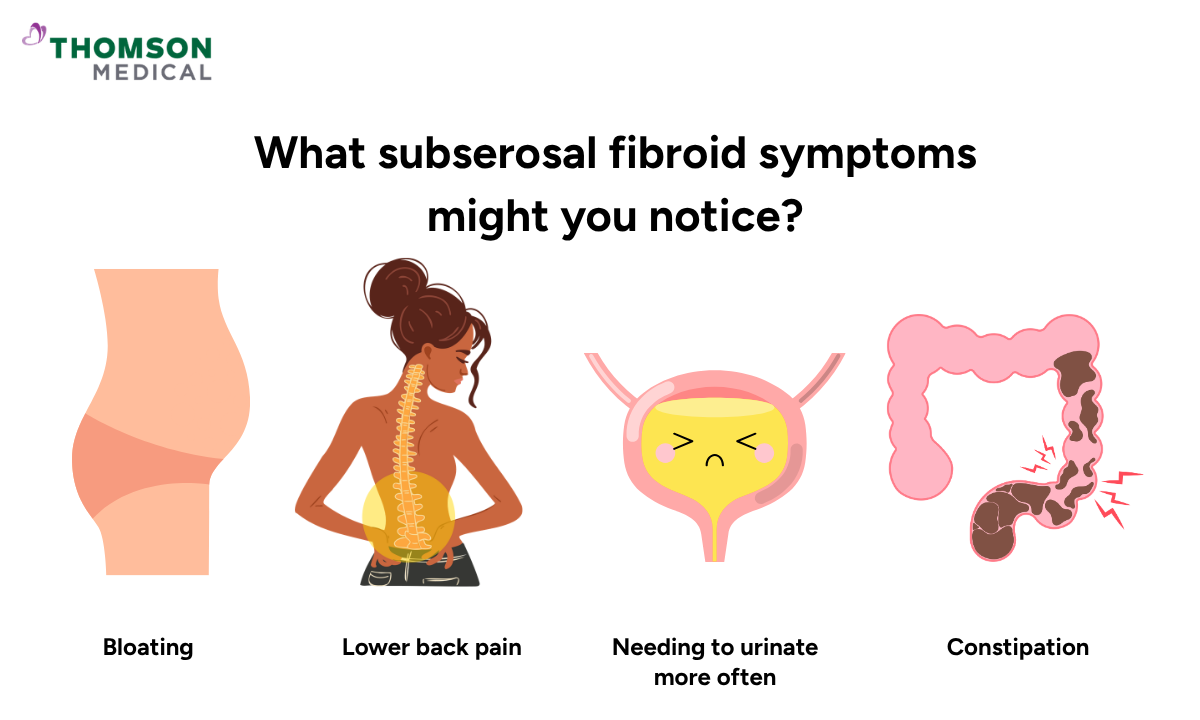 Illustration shows the subserosal fibroid symptoms might you notice