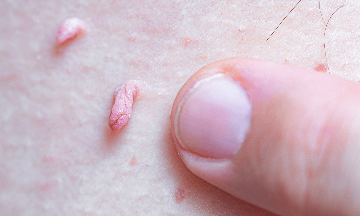 image of hpv warts in man