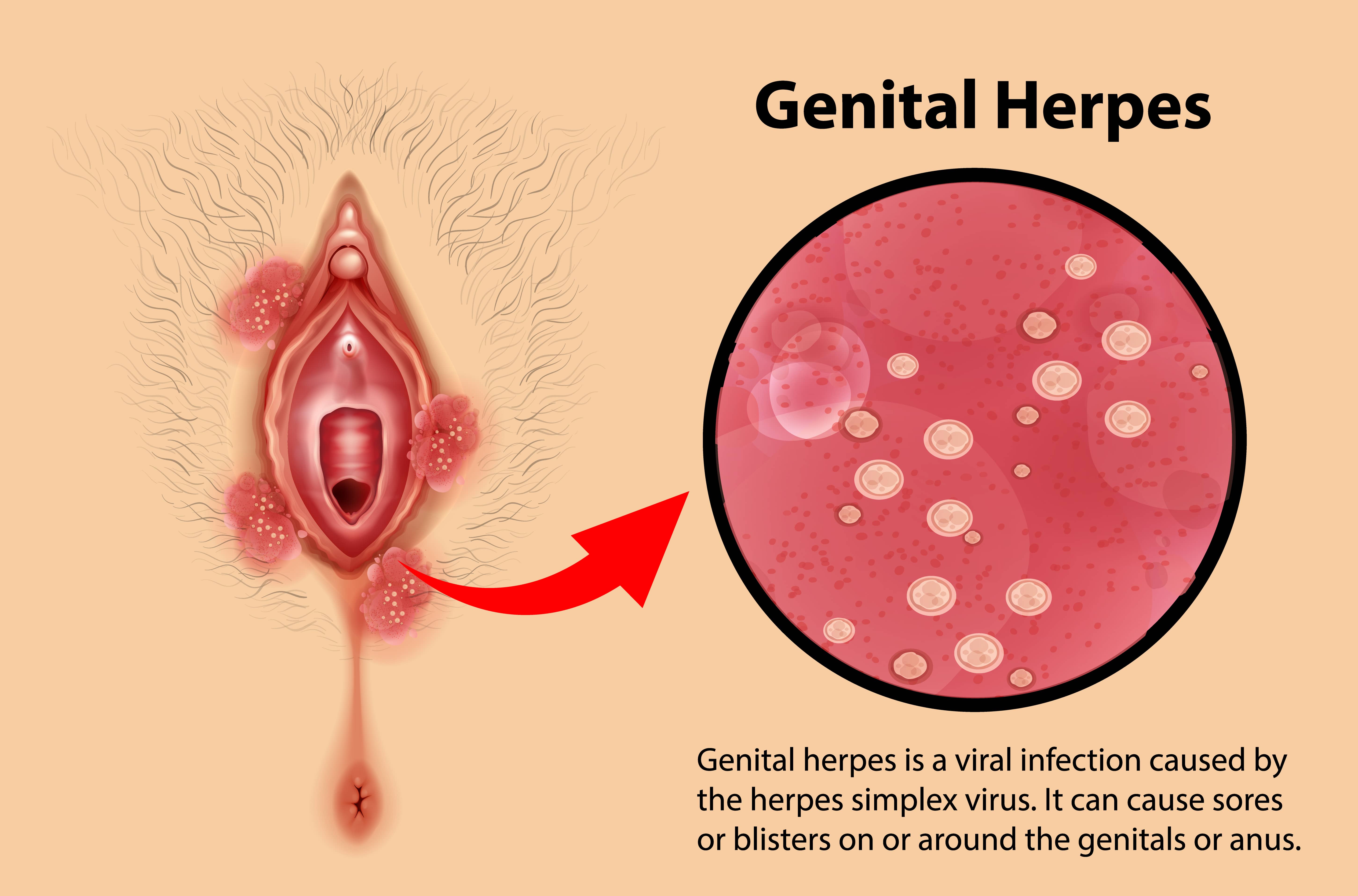blog-image_obgyn_genital-herpes.jpg
