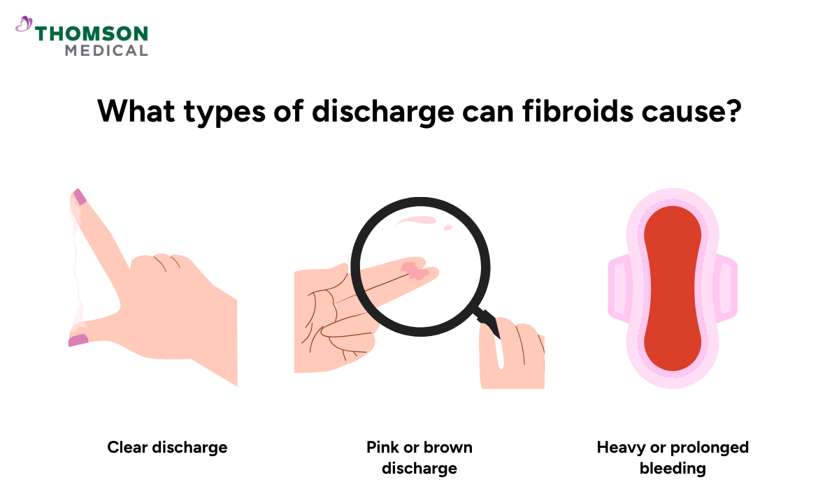 illustration of what types of discharge can fibroids cause