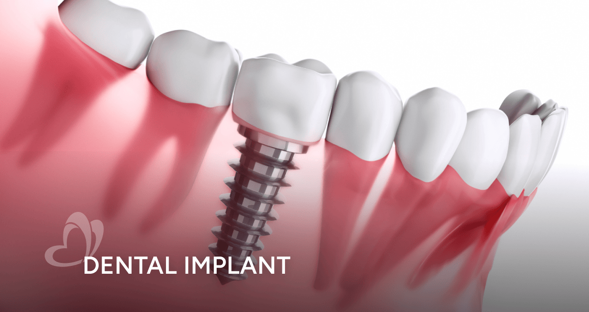 Dental Implants in Singapore: Benefits, Costs & What to Expect ...