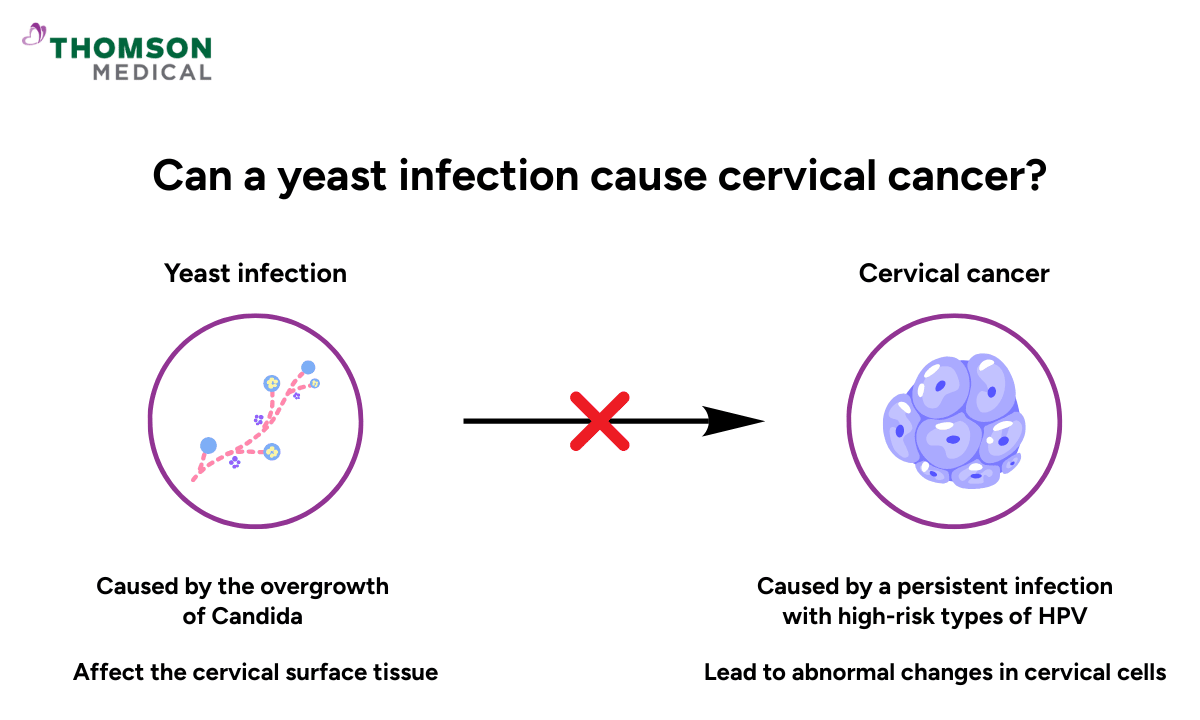 image of connection between a yeast infection and cervical cancer