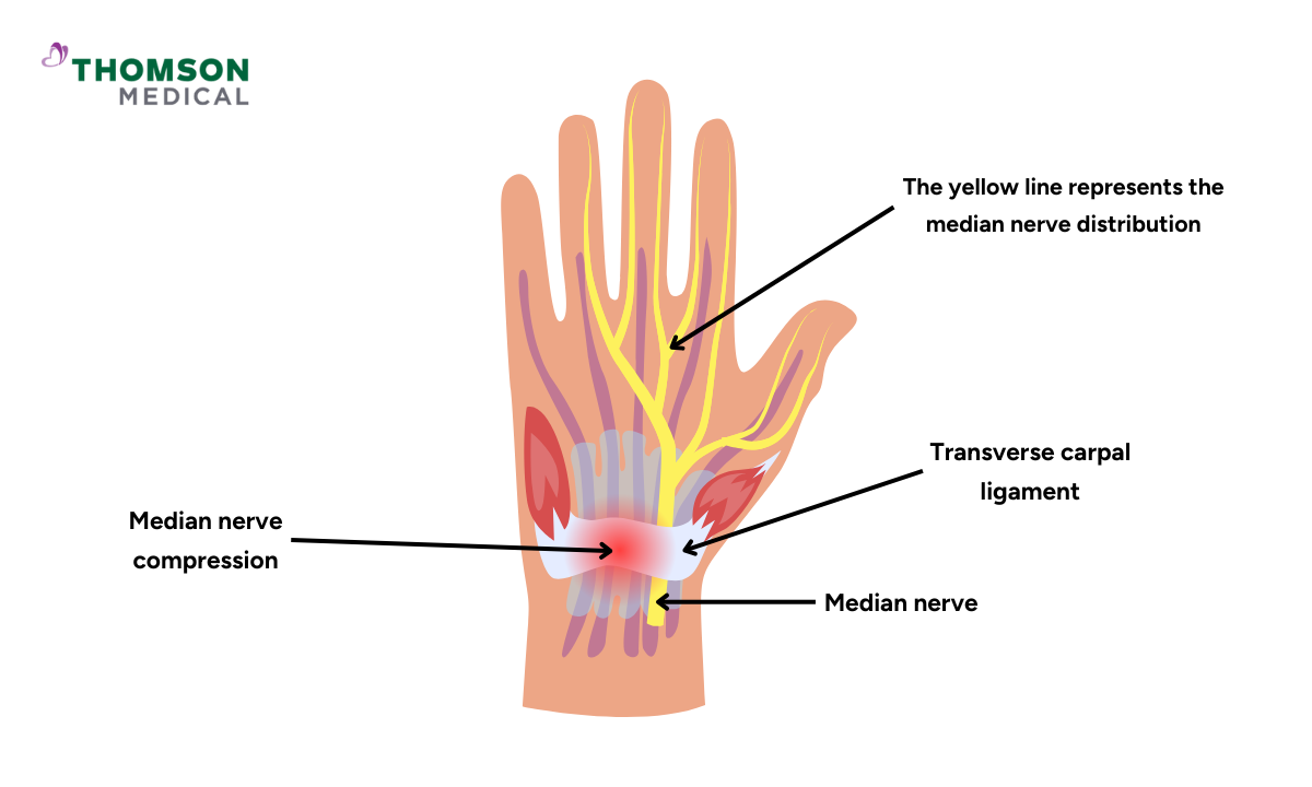 blog-image_screening_median-nerve.png