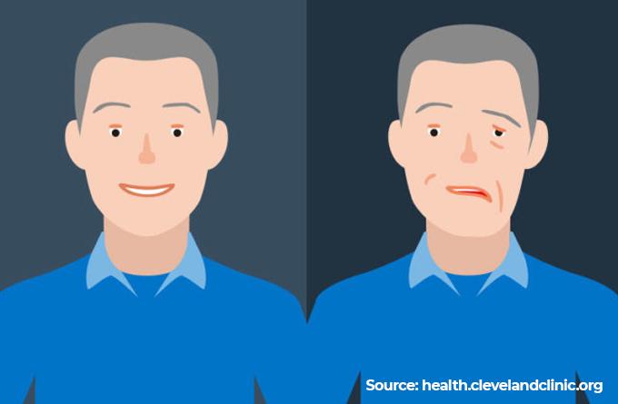 4 Reasons to Consider TCM for Bell’s Palsy Treatment 2.jpg