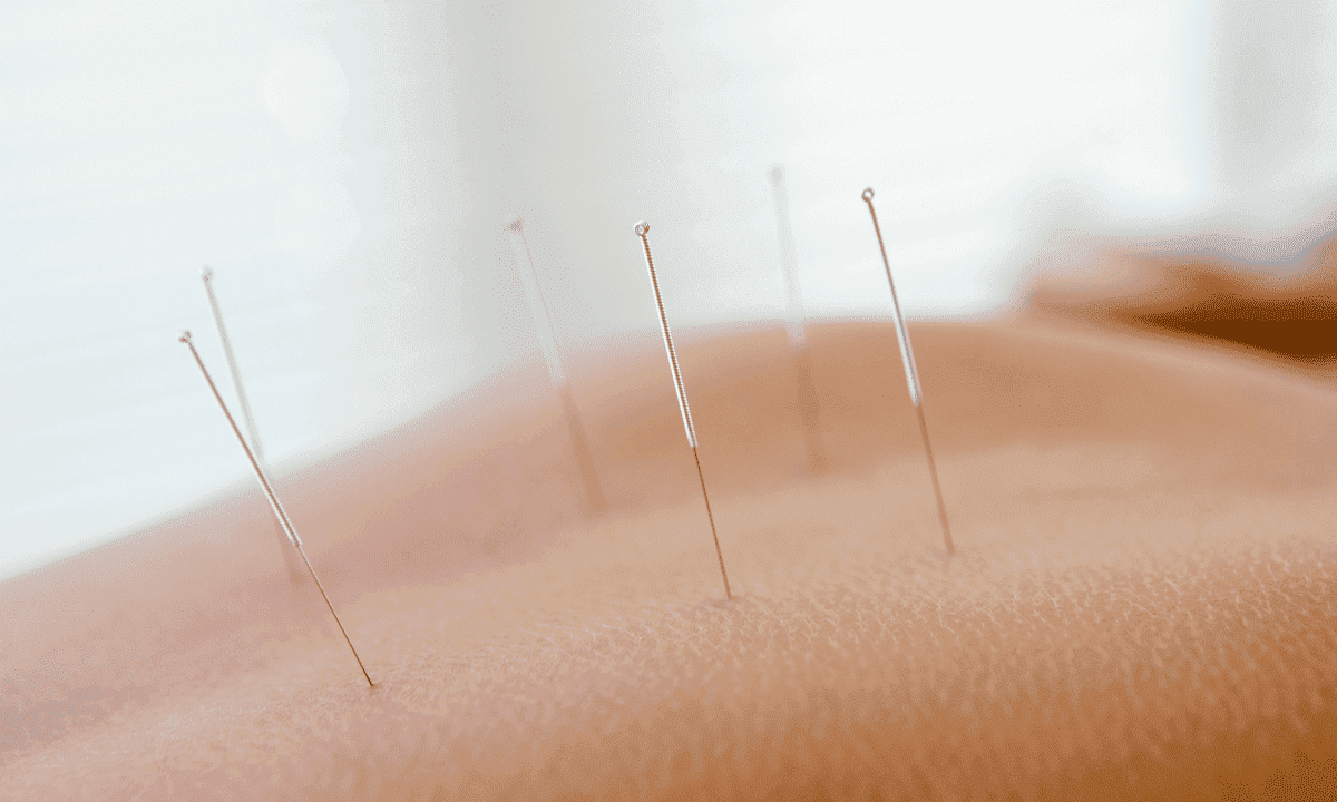 Close-up of several acupuncture needles inserted into a person's back.