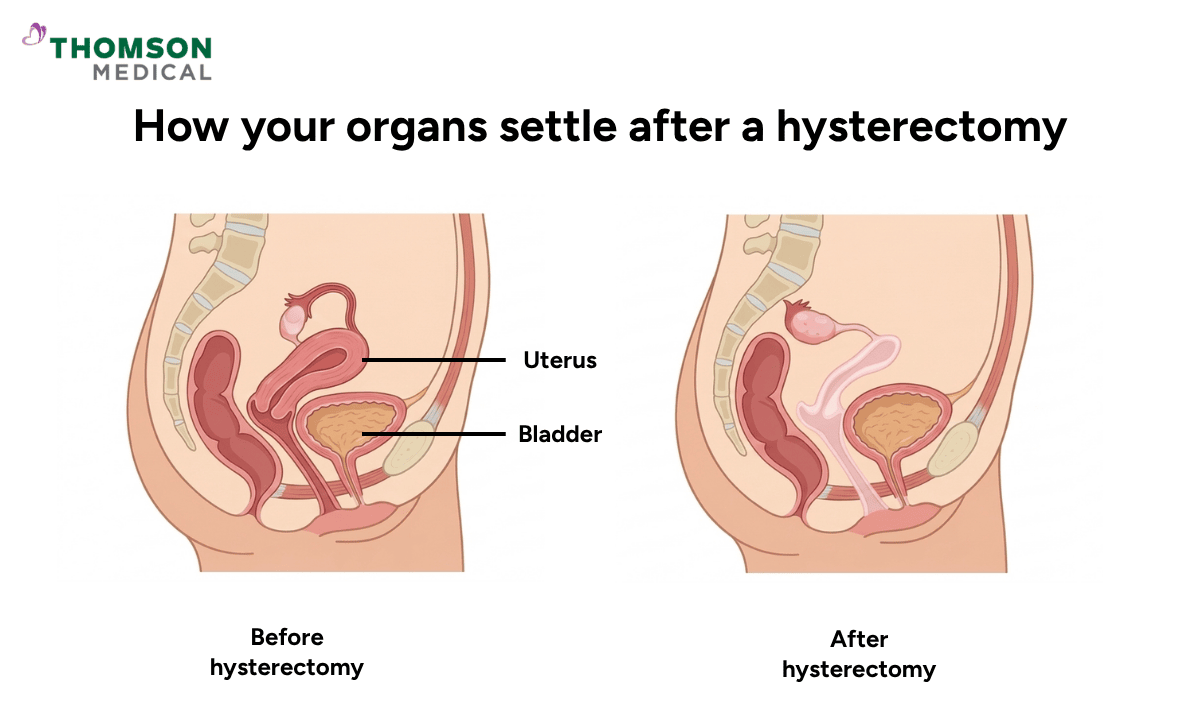Illustration of how your organs settle after a hysterectomy before and after