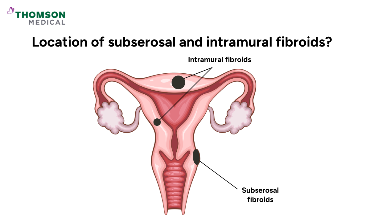 Illustration of subserol and intramural fibroids