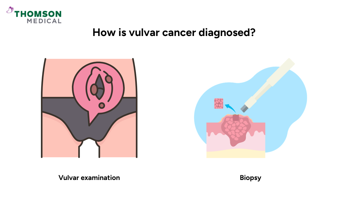 Illustration of how is vulvar cancer diagnosed