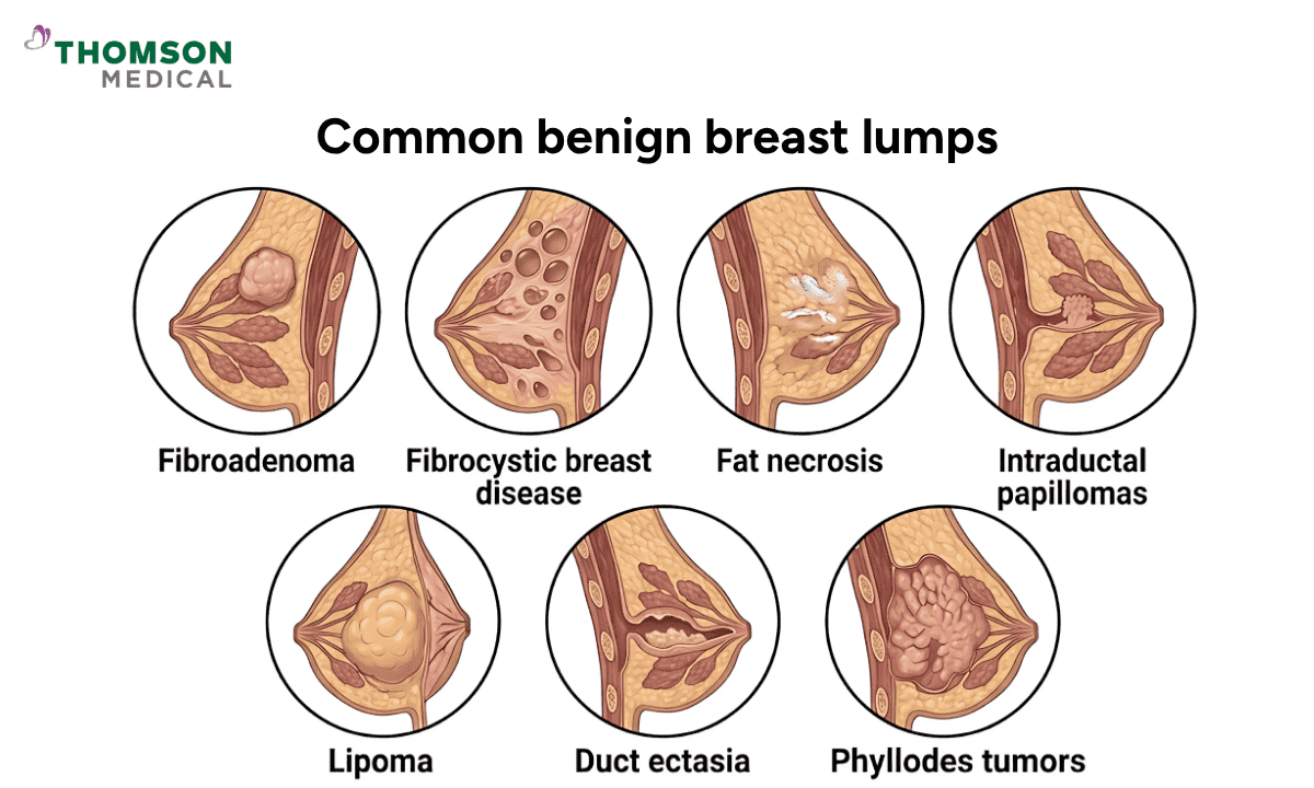 types of benign breast lumps