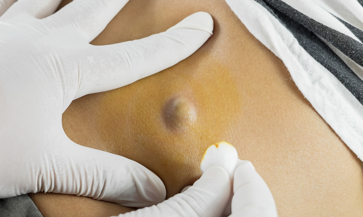 Illustration of a cyst