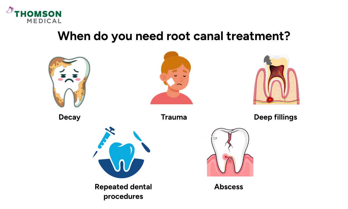 signs when you need root canal treatment