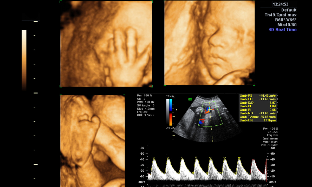 4d ultrasound