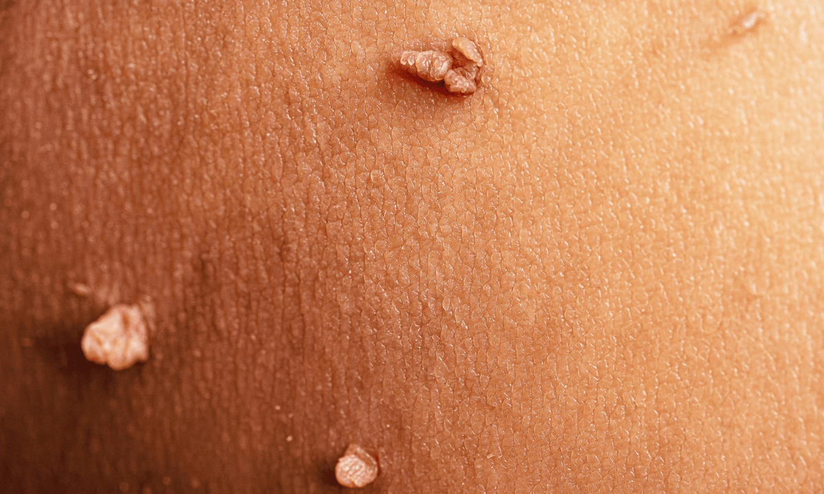 image of skin warts