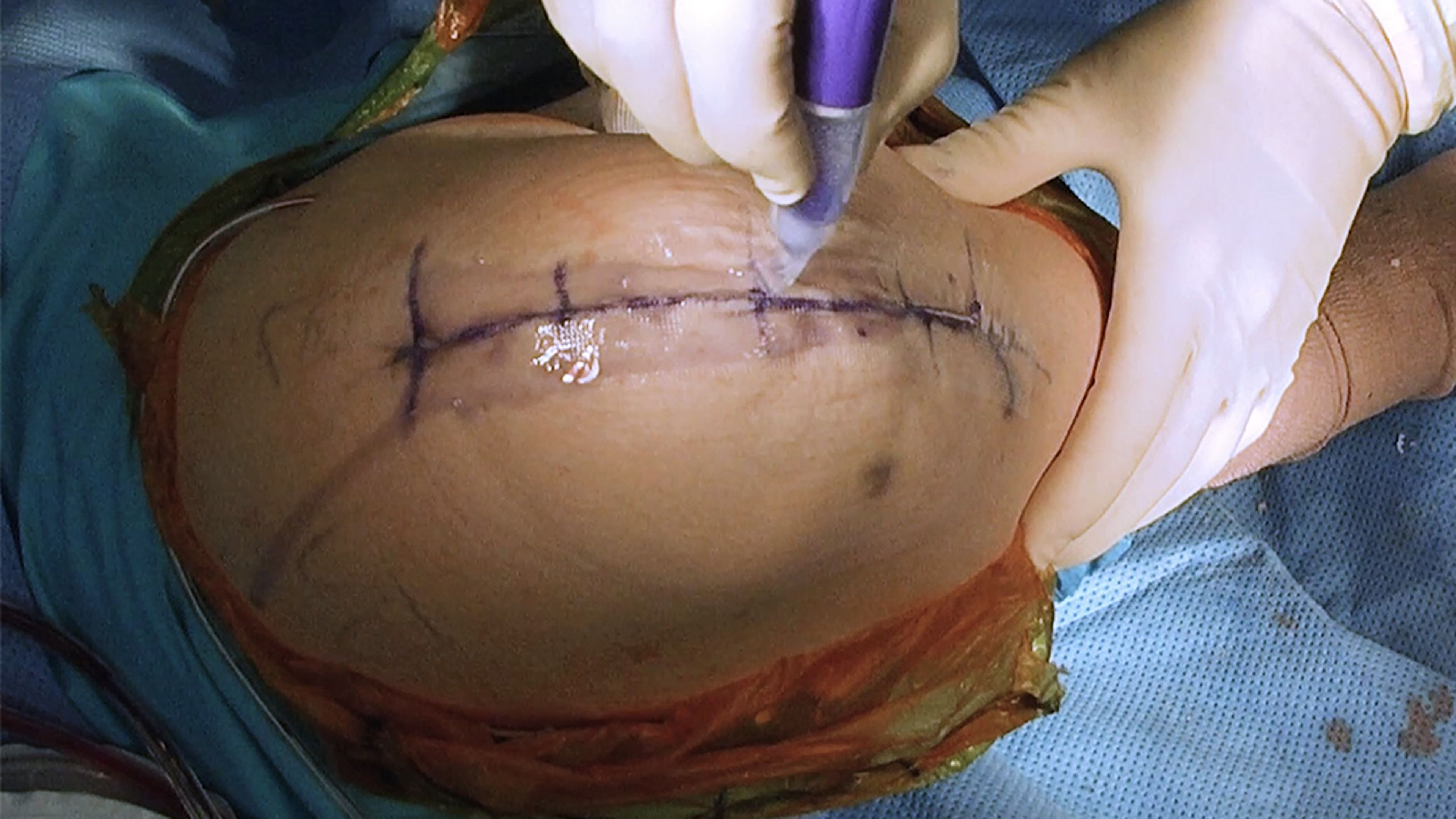 US_ETH_WOUN_111840.1 - Total Knee Replacement using DERMABOND™ PRINEO™ Skin Closure System with James Dowd, MD