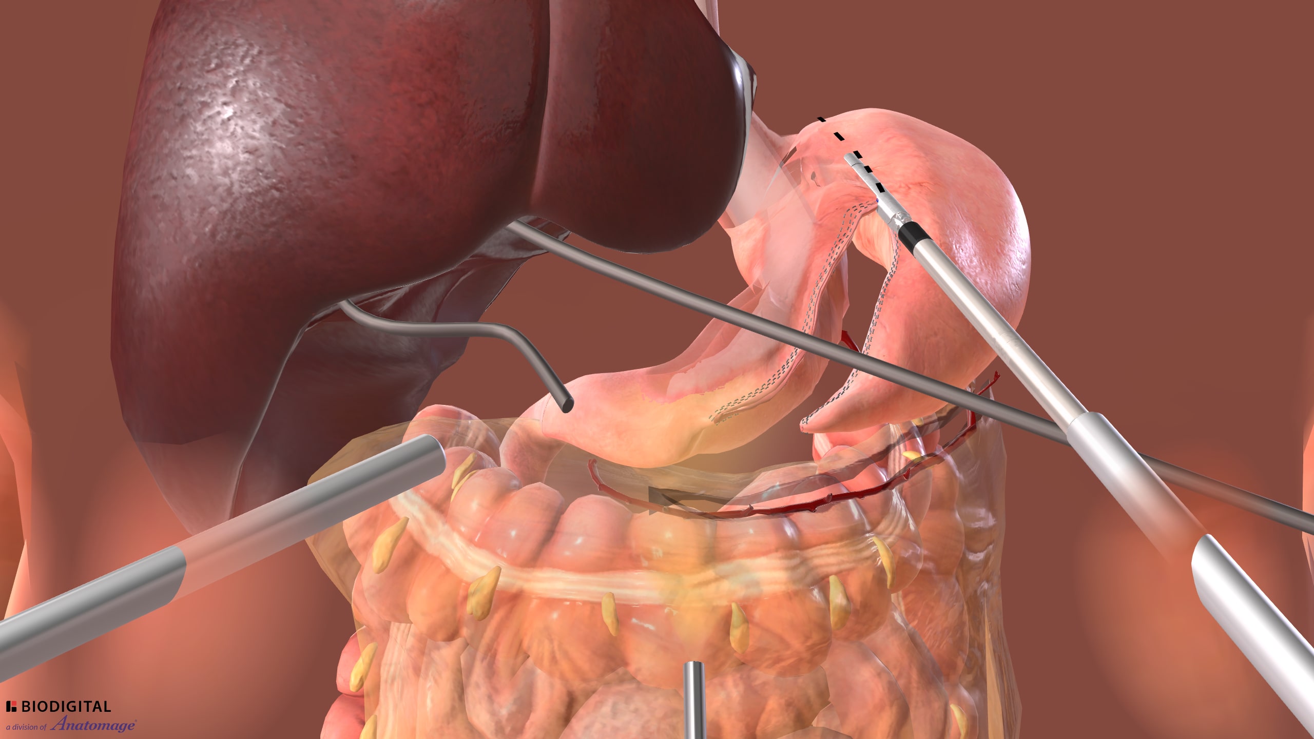 Laparoscopic Sleeve Gastrectomy