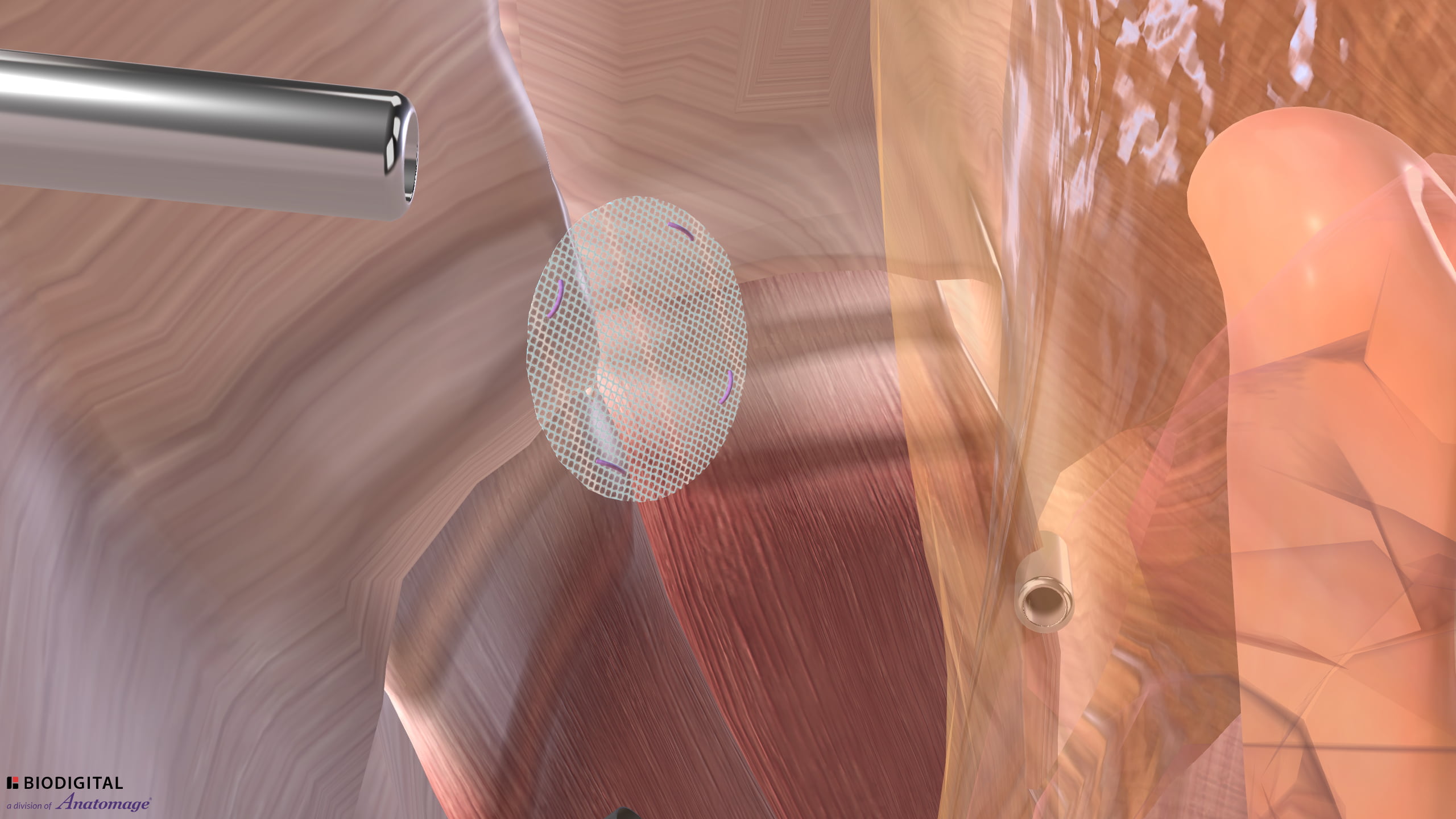 Ventral Hernia Repair - Medium Hernia with Mesh